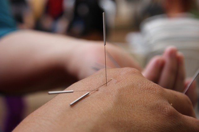 5 Best Acupuncture in Wellington